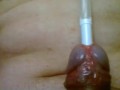 Urethral insertion with pen