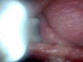 Endoscope camera shows the most sensitive parts of the penis Educational video