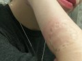 Self Biting with Perfect Teeth Impressions