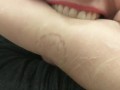 Self Biting with Perfect Teeth Impressions