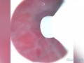 CAMERA INSIDE VAGINA AFTER INTERNAL CREAMPIE - ส่องกล้องดูอสุจิในช่องคลอด