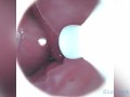CAMERA INSIDE VAGINA AFTER INTERNAL CREAMPIE - ส่องกล้องดูอสุจิในช่องคลอด