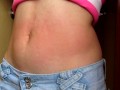 I show my red belly from the torture I received from the red belly game, my stomach inflamed