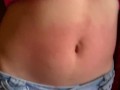 I show my red belly from the torture I received from the red belly game, my stomach inflamed