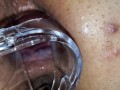 BBW extreme anal and asshole speculum gape