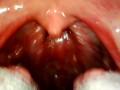 My throat with endoscope
