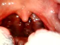 My throat with endoscope