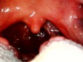 My throat with endoscope