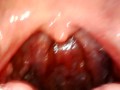 My throat with endoscope