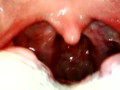My throat with endoscope