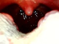 My throat with endoscope