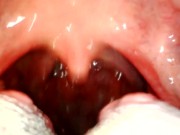 My throat with endoscope