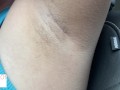 armpit hair even after laser removal - glimpseofme