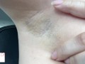 armpit hair even after laser removal - glimpseofme
