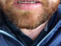 SFW Behind the Scenes look at my newly untied tongue immediately before & after surgery today  