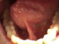 SFW Behind the Scenes look at my newly untied tongue immediately before & after surgery today  