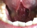 SFW Behind the Scenes look at my newly untied tongue immediately before & after surgery today  