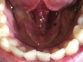 SFW Behind the Scenes look at my newly untied tongue immediately before & after surgery today  