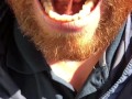 SFW Behind the Scenes look at my newly untied tongue immediately before & after surgery today  