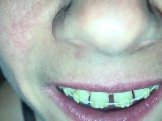 Cum play with retainer.