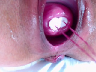 2 tampones in cervix extrem