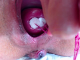 2 tampones in cervix extrem