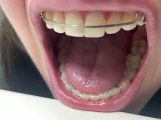 Retainer Mouth Closeup (PREVIEW)