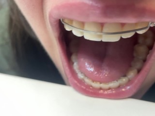 Retainer Mouth Closeup (PREVIEW)