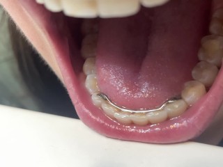 Retainer Mouth Closeup (PREVIEW)