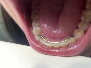 Retainer Mouth Closeup (PREVIEW)