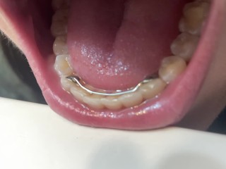 Retainer Mouth Closeup (PREVIEW)
