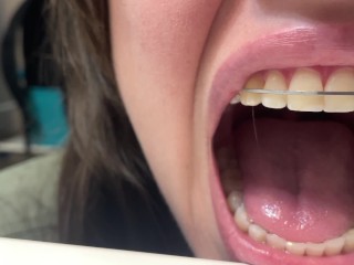 Retainer Mouth Closeup (PREVIEW)