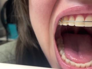 Retainer Mouth Closeup (PREVIEW)