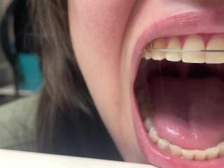 Retainer Mouth Closeup (PREVIEW)