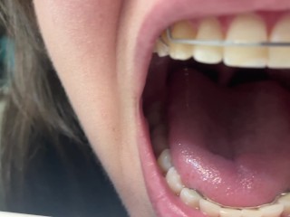 Retainer Mouth Closeup (PREVIEW)