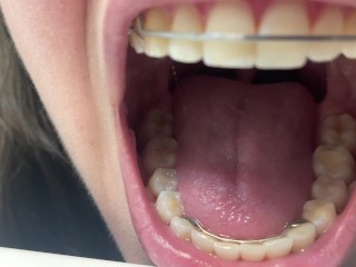 Retainer Mouth Closeup (PREVIEW)