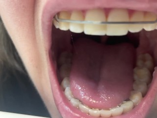 Retainer Mouth Closeup (PREVIEW)