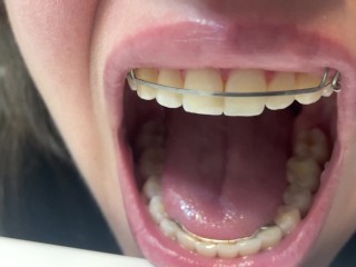 Retainer Mouth Closeup (PREVIEW)