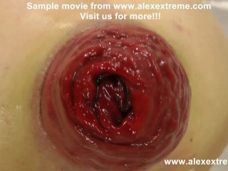 Extreme anal fisting, huge dildos and prolapse compilation from alexextreme 30-46