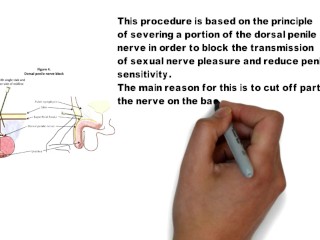 Premature Ejaculation Treatment Tutorial 1-4