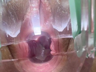 Cervix Close-Up with Speculum