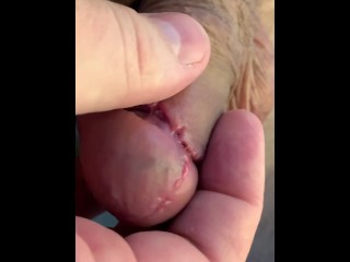 Circumcision day #9 👍