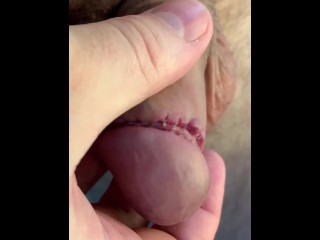 Circumcision day #9 👍