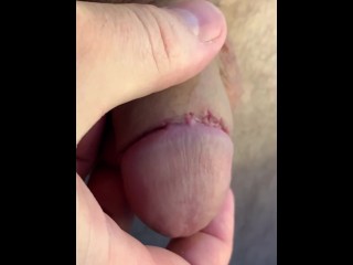 Circumcision day #9 👍