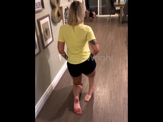 Rotationplasty Amputee walks on her little leg
