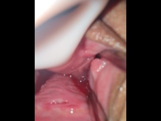 Dilator Peehole play