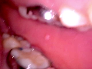 Inside my mouth with braces