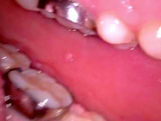 Inside my mouth with braces