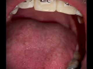 MY PERFECT BRACES