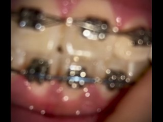 MY PERFECT BRACES